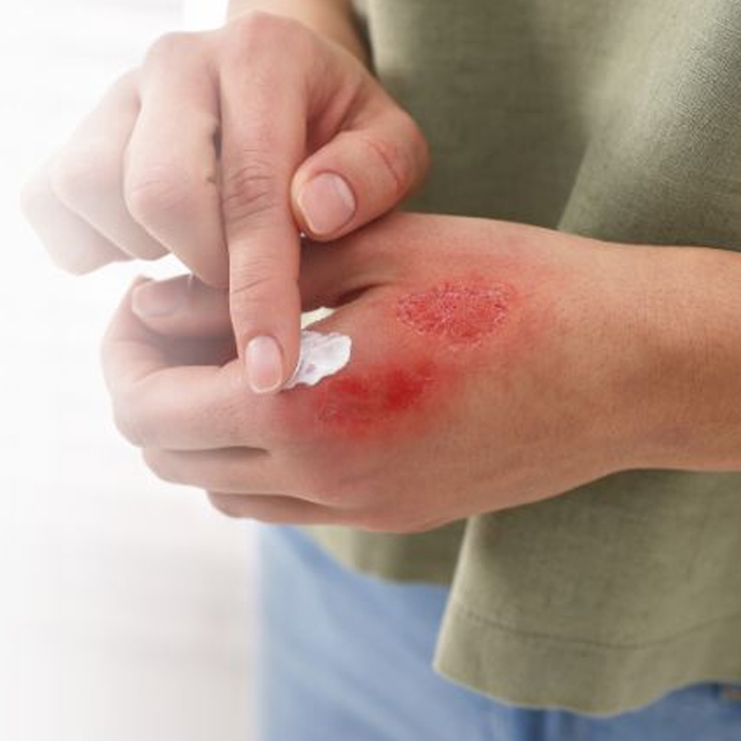 Burn Ointment available in online  pharmacy qatar, doha 